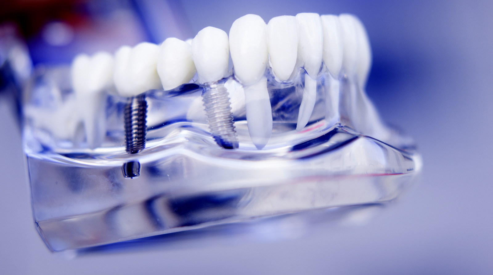 The Dos and Don’ts After Implant Placement