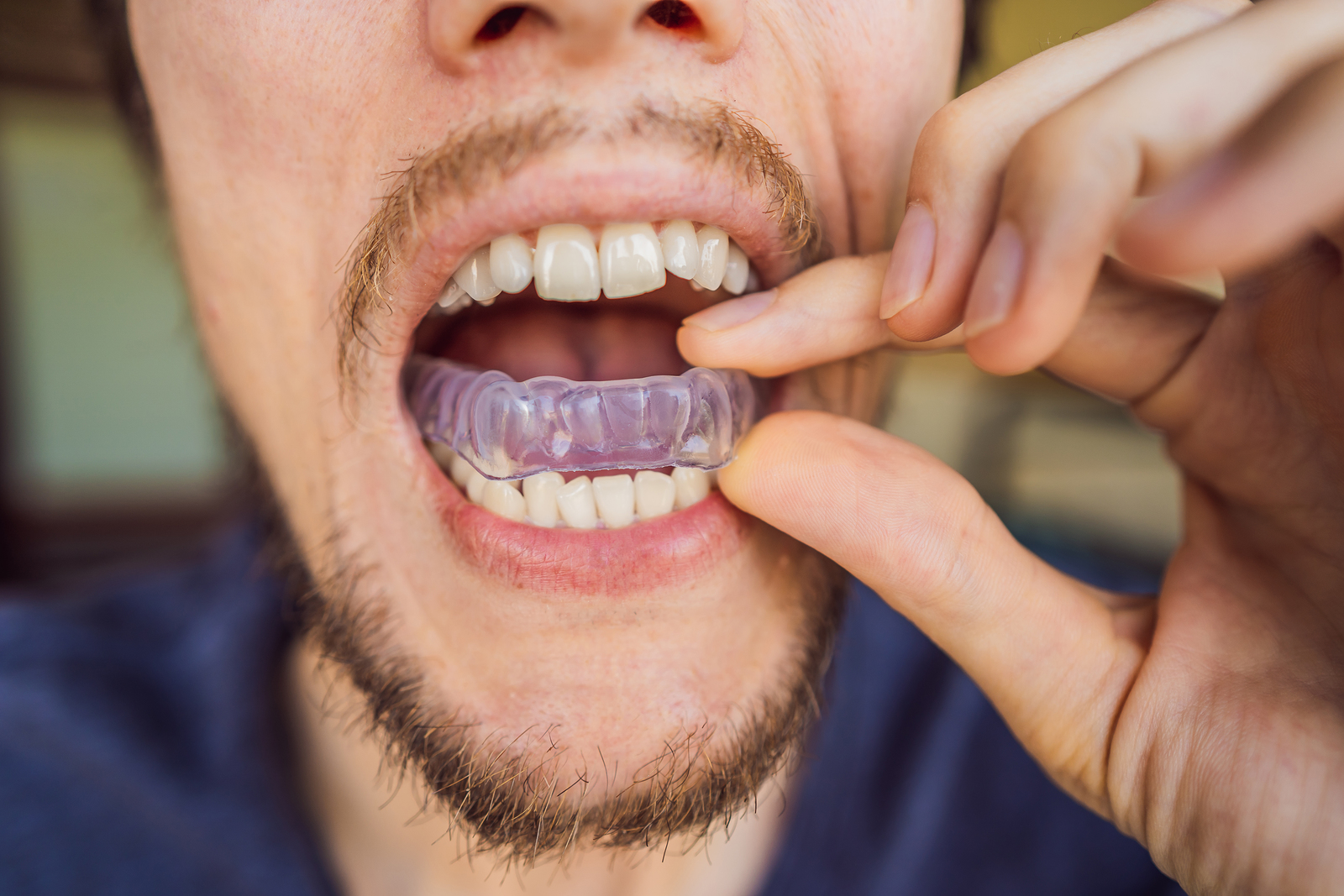 Nightguards: What are They, and Why do I Need to Wear One?
