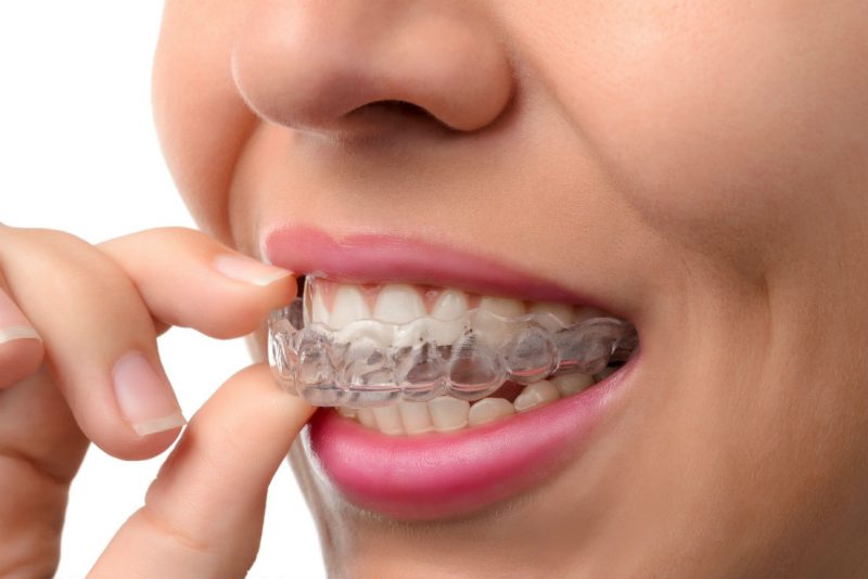 ClearCorrect – What Do You Need To Know